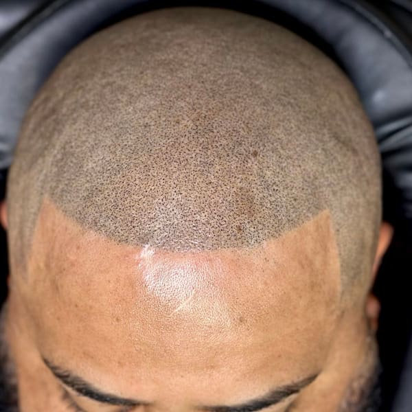 Angel Scalp Micro - permanent makeup in Kingston, PA