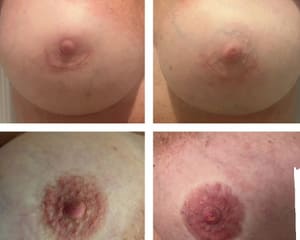 Areola Tattoo result by Aesthetic Permanent Beauty in Lake Worth Beach, FL