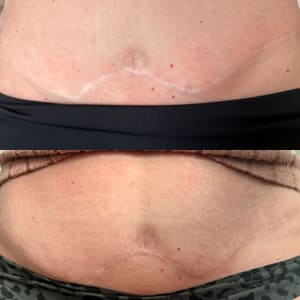 Areola Tattoo result by Barely There Tattoo in Helper, UT