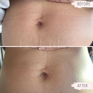 Areola Tattoo result by Beauty Mark Dallas in Dallas, TX