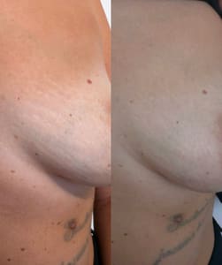Areola Tattoo result by Beauty Point in Los Angeles, CA
