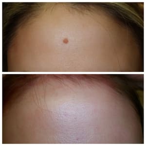Areola Tattoo result by Bella Cosmedica in Pickerington, OH
