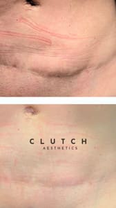 Areola Tattoo result by Clutch Aesthetics in Boise, ID