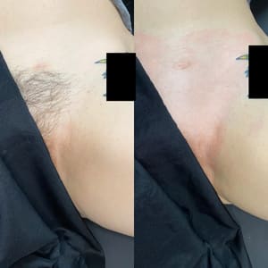 Areola Tattoo result by Desired Esthetics in Cary, NC