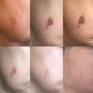 Areola Tattoo result by Hera Spa and Permanent Makeup in Leeds, UT