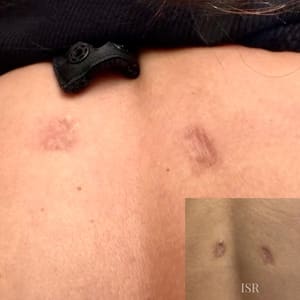 Areola Tattoo result by House of Pigmentation in Feasterville Trevose, PA