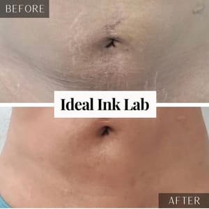 Areola Tattoo result by Ideal Ink Lab in Cutler Bay, FL