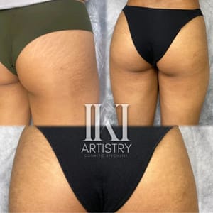 Areola Tattoo result by Iki Artistry in Garden Grove, CA