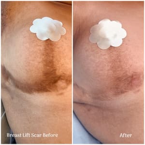 Areola Tattoo result by Invisible Skin Help in Miami, FL