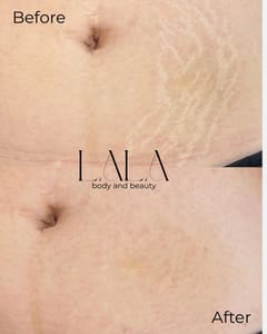 Areola Tattoo result by LALA body and beauty in Maplewood, MN