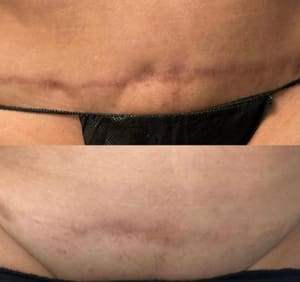Areola Tattoo result by LALA body and beauty in Maplewood, MN