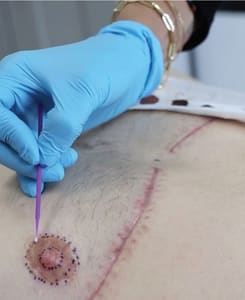 Areola Tattoo result by Paramedical Pro in Folsom, CA