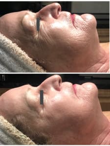 Areola Tattoo result by Resolutions Med Spa in Monroeville, PA