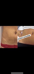 Areola Tattoo result by Skinspiration- Stretch Mark & Scar Camouflage Studio in Houston, TX