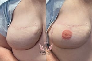 Areola Tattoo result by Solouro Micropigmentation in Union, NJ