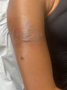 Areola Tattoo result by Vidal Ink Skin Camouflage-Lip Blushing in Woodside, NY