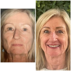 Eyebrow Tattoo result by Advanced Cosmetic Techniques in Natchitoches, LA