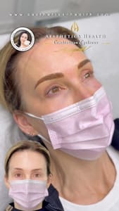 Eyebrow Tattoo result by Aesthetics Health in Mclean, VA