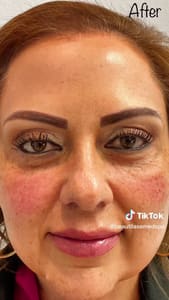 Eyebrow Tattoo result by Beautilase Med Spa in Mission, TX