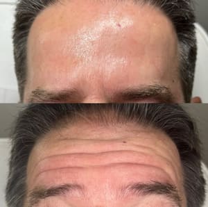 Eyebrow Tattoo result by Bloomhaus Medspa & Wellness - Miramar in Miramar, FL