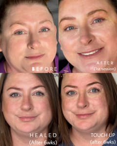 Eyebrow Tattoo result by Brow.RN_ in Minneapolis, MN