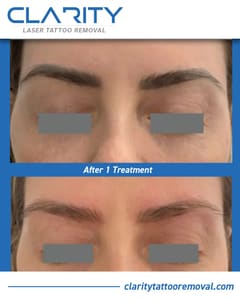 Eyebrow Tattoo result by Clarity Tattoo Removal in Somerville, MA