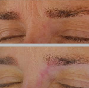 Eyebrow Tattoo result by CosMedic Studio in Mamaroneck, NY