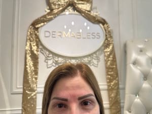 Eyebrow Tattoo result by Dermabless in Miami, FL