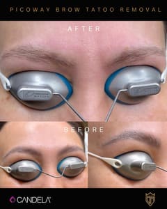 Eyebrow Tattoo result by DMV Beauty Clinic in Mclean, VA