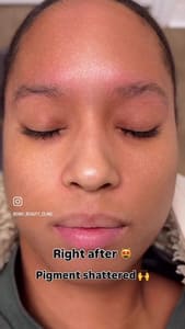 Eyebrow Tattoo result by DMV Laser Beauty Clinic in Tysons, VA