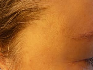 Eyebrow Tattoo result by Hair Free Skin - Dallas Electrolysis & School in Dallas, TX