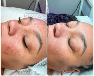 Eyebrow Tattoo result by Keyla Sanchez Aesthetics in Mckinney, TX