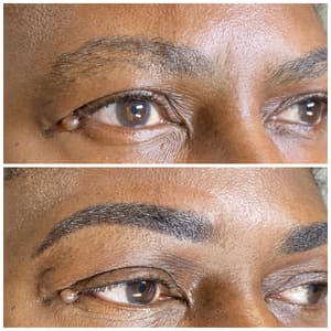 Eyebrow Tattoo result by Laser Center Of Melbourne in Melbourne, FL