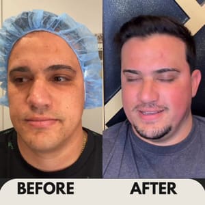 Eyebrow Tattoo result by Luxury Aesthetics Center in Malden, MA