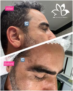 Eyebrow Tattoo result by MB Advanced Med Spa & Beauty in Sunny Isles Beach, FL