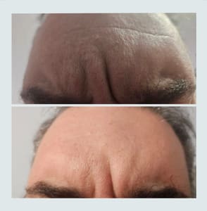 Eyebrow Tattoo result by Medical Aesthetics of NJ in East Brunswick, NJ