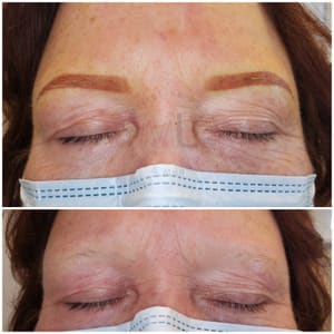 Eyebrow Tattoo result by MicroLine PMU: Cosmetic & Medical Tattoo Clinic in Westwood, NJ