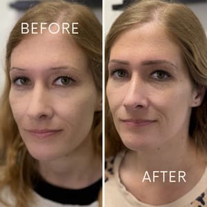 Eyebrow Tattoo result by Nasri Aesthetics in Costa Mesa, CA