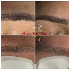Eyebrow Tattoo result by Premier Tattoo Removal in Mckinney, TX