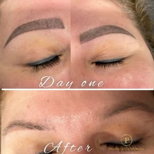 Eyebrow Tattoo result by Premier Tattoo Removal in Mckinney, TX