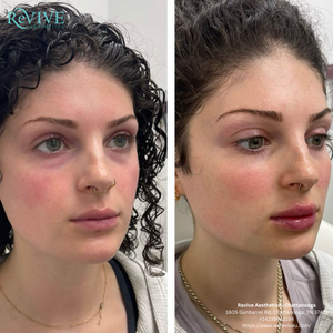Eyebrow Tattoo result by Revive Aesthetics - Chattanooga in Chattanooga, TN