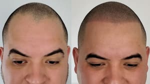 Eyebrow Tattoo result by Scalpp Clinic - Scalp Micropigmentation Austin in Austin, TX
