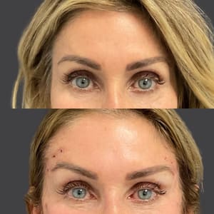 Eyebrow Tattoo result by Skin Perfect Medical Aesthetics in Costa Mesa, CA