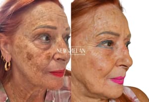 Eyebrow Tattoo result by SkinArtMed by Maria Nunez in Miami, FL