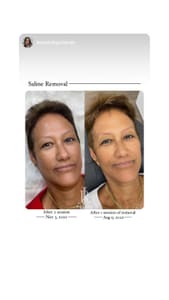 Eyebrow Tattoo result by SkinLabhi in Aiea, HI