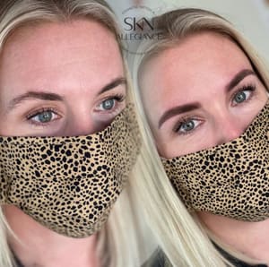Eyebrow Tattoo result by SKN ALLEGIANCE Laser tattoo & Permanent makeup removal in Huntingdon Valley, PA