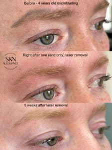 Eyebrow Tattoo result by SKN ALLEGIANCE Laser tattoo & Permanent makeup removal in Huntingdon Valley, PA