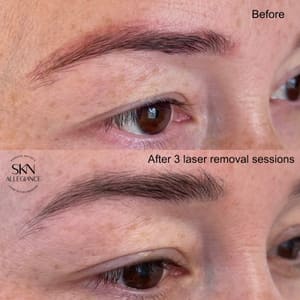 Eyebrow Tattoo result by SKN ALLEGIANCE Laser tattoo & Permanent makeup removal in Huntingdon Valley, PA