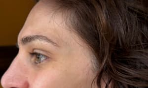Eyebrow Tattoo result by Whoopsie Daisy Tattoo Removal in Martinsburg, WV