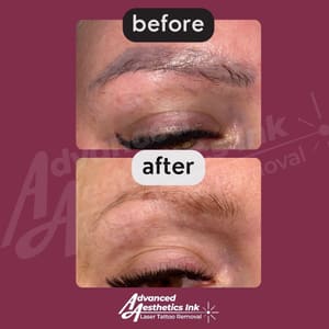 Eyeliner Tattoo result by Advanced Aesthetics Ink Laser Tattoo Removal in South Dartmouth, MA